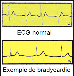 Bradycardie